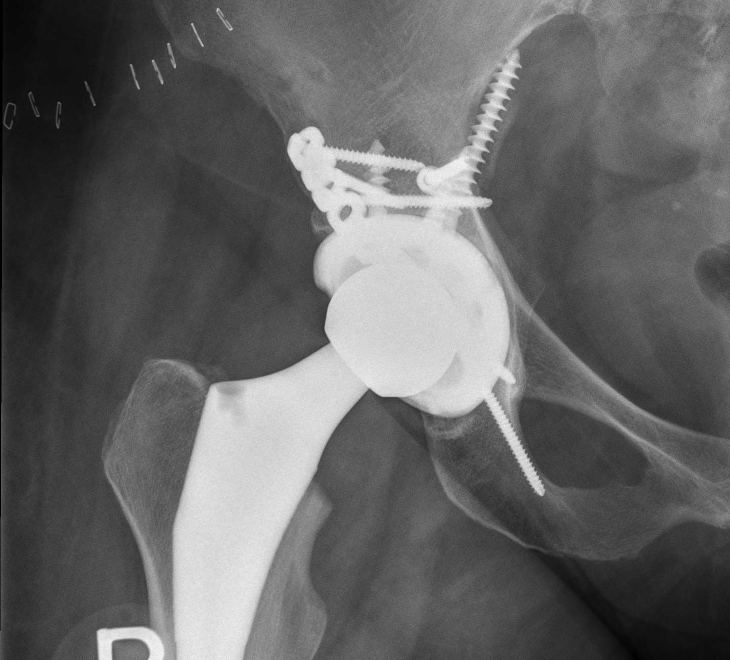 THR Fractured Acetabulum